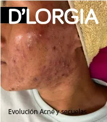 Evolución de la piel de un paciente tras el tratamiento para acné (2 de 4)