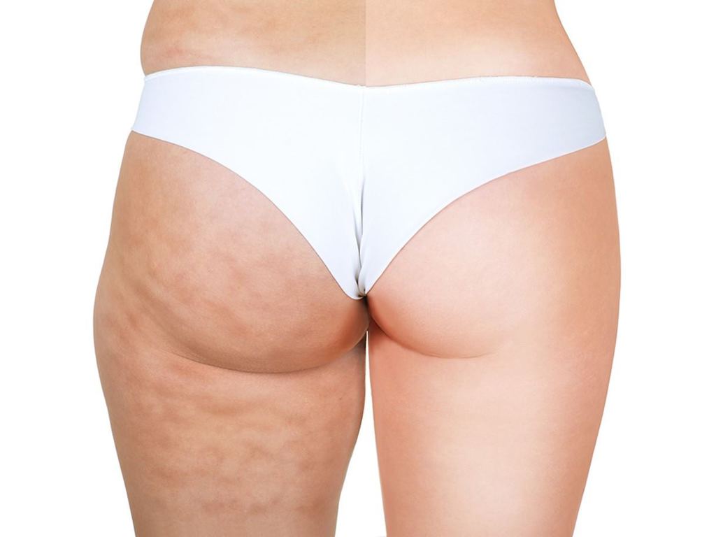 Carboxiterapia corporal