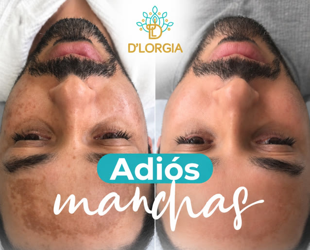 Antes y después: adiós manchas en DLorgia