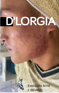 Evolución de un paciente tras su tratamiento para acné: foto 3 de su evolución