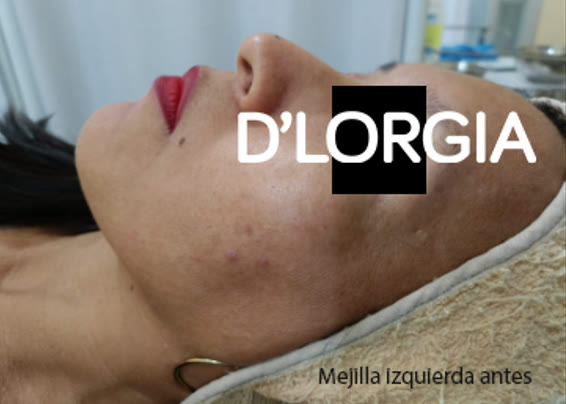 Antes y después de una paciente tras su tratamiento para manchas: foto 1 de su evolución