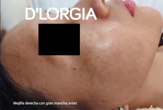 Antes y después de una paciente tras su tratamiento para manchas: foto 3 de su evolución