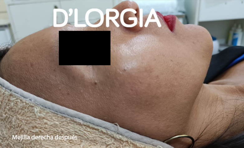Antes y después de una paciente tras su tratamiento para manchas: foto 4 de su evolución
