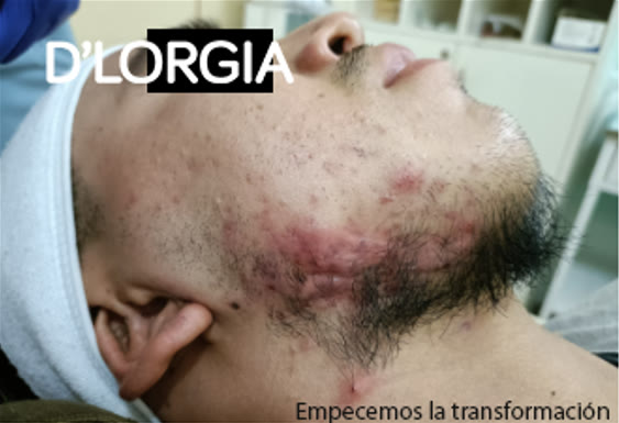 Evolución de un paciente tras su tratamiento para acné activo y quístico: foto 2 de su evolución