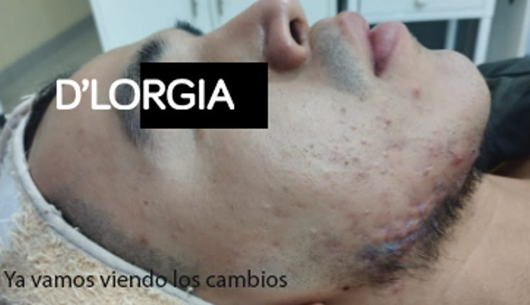 Evolución de un paciente tras su tratamiento para acné activo y quístico: foto 3 de su evolución