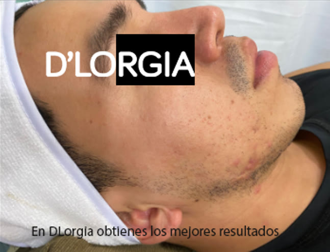 Evolución de un paciente tras su tratamiento para acné activo y quístico: foto 4 de su evolución