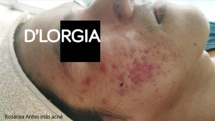 Evolución de un paciente tras su tratamiento para rosácea y acné: foto 1 de su evolución