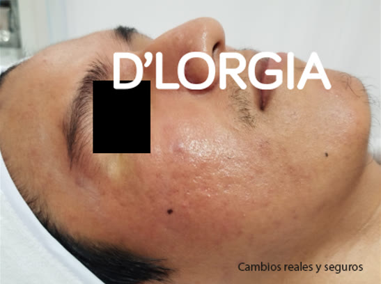 Evolución de un paciente tras su tratamiento para rosácea y acné: foto 2 de su evolución