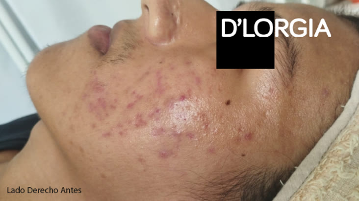 Evolución de un paciente tras su tratamiento para rosácea y acné: foto 3 de su evolución