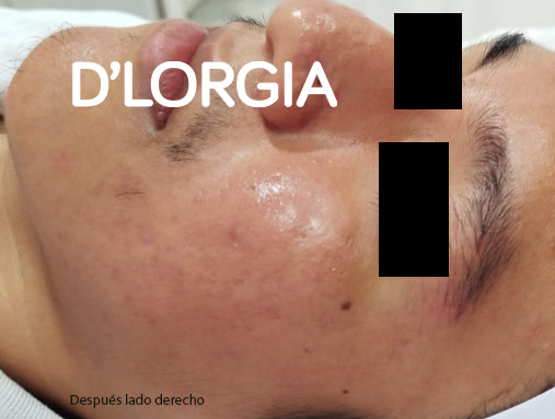 Evolución de un paciente tras su tratamiento para rosácea y acné: foto 4 de su evolución