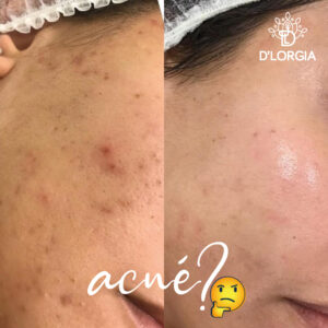 Tratamiento-Acne-Piura