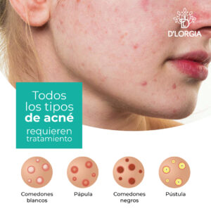 Tratamiento-Acne-Huancayo